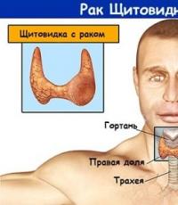 Какой прогноз при медуллярном раке щитовидной железы?